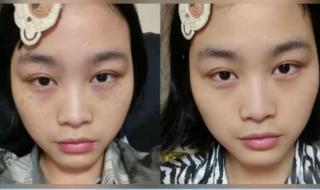 什么产品去斑最好 最好的去斑产品